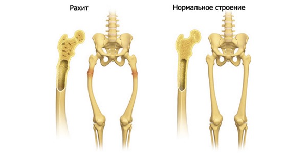 Рахит - еще одно заболевание, способствующее развитию кифоза