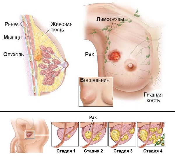 Назначить препарат могут при онкологии простаты и молочной железы
