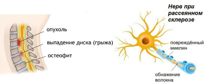 Используют Мидокалм Рихтер при нарушениях работы ЦНС
