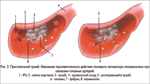 распад тромба