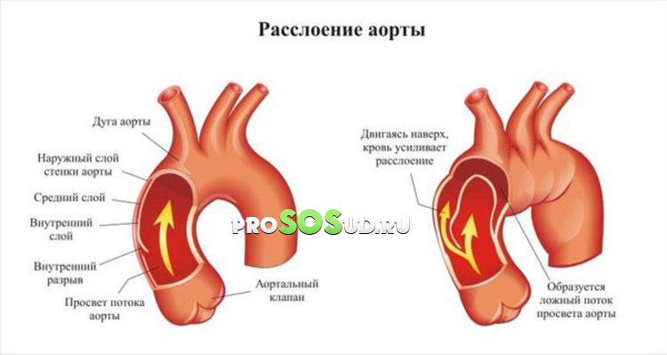расслоение аорты