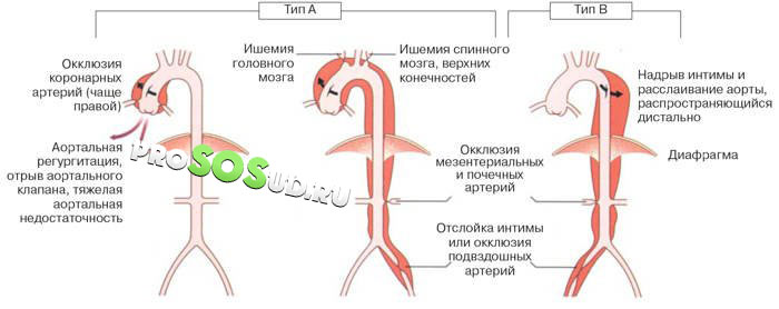 разновидности расслоения