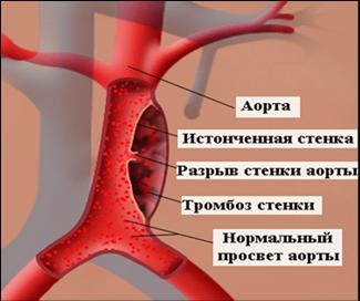 разрыв аорты