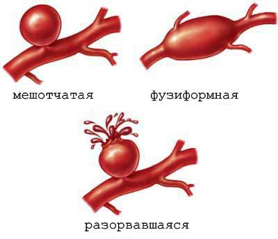 разрыв аневризмы