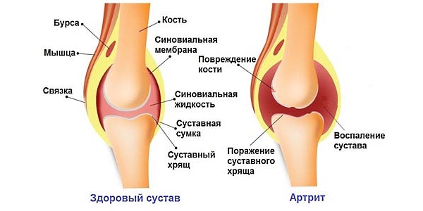 Таблетки Бутадион назначают при артрите и для купирования болей различной этиологии