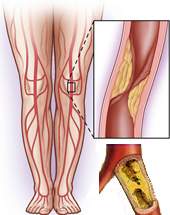 Развитие эндартерита