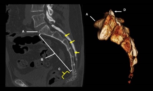 При переломе копчика в первую очередь проводят рентген