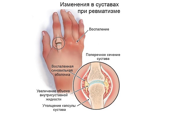 Используют Нимику при ревматических и суставных болезнях