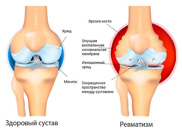 Препарат Дикловит применяют при ревматических заболеваниях