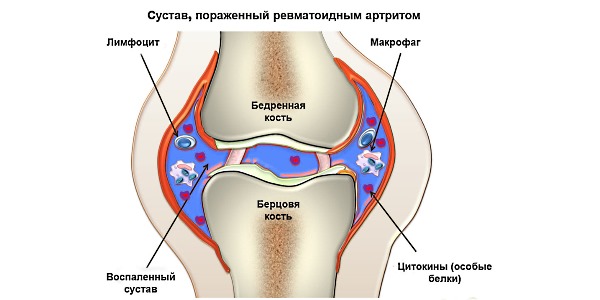 Благодаря составу препарата его назначают при ревматоидном артрите
