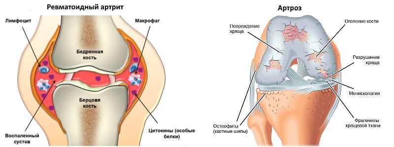 Назначают препарат для устранения болей при артрите и артрозе