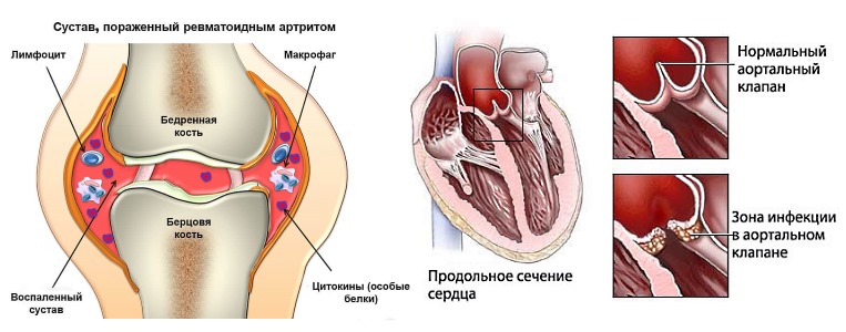 Используют противовоспалительное Наклофен Дуо при ревматизме и его последствиях
