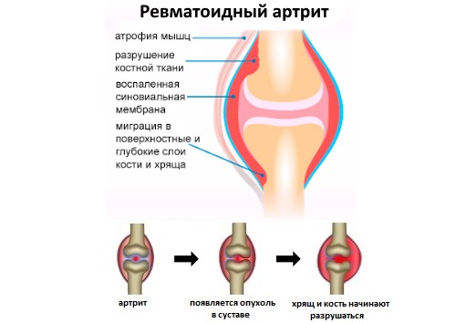 Араву назначают для лечения ревматоидного артрита