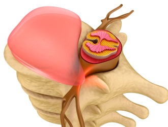 При наличии больших грыж могут рекомендовать кесарево сечение