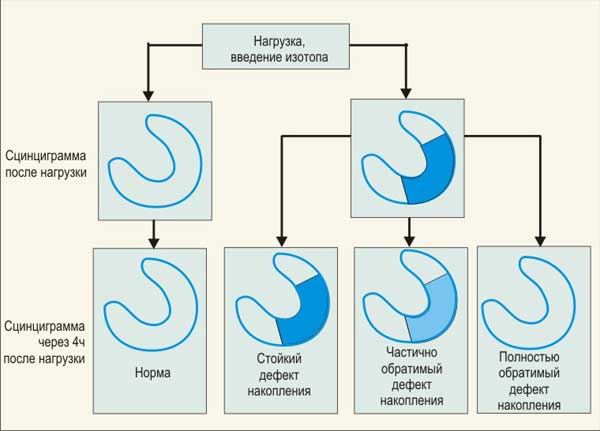 результаты сцинтиграфии