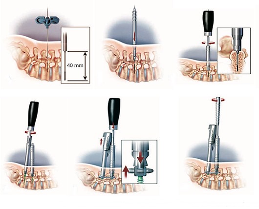 Ниже описаны этапы проведения операции