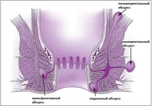 Виды и расположение абсцессов