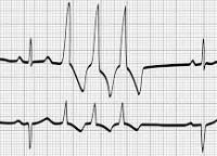 ритм сердца