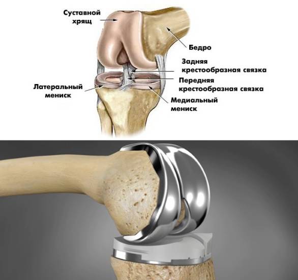 Для печати протеза был использован материал под названием тантал