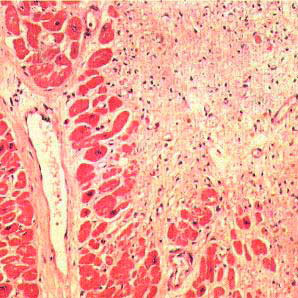 рубцы на тканях сердца
