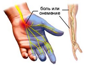 Основной симптом цервикобрахиалгии - это боль в шее и руке