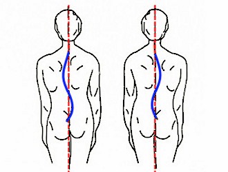 На последней стадии сколиоза позвоночник приобретает S-образную форму