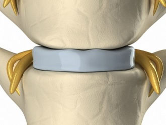 При отсутствии лечения сакрализации могут разрушаться межпозвонковые диски поясничного отдела