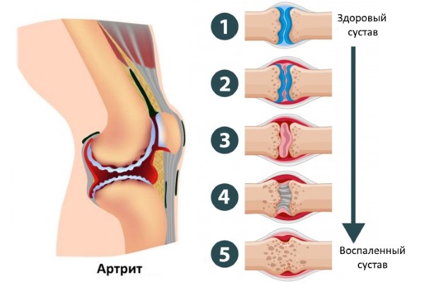 Назначают Ацеклофенак преимущественно при ревматоидном артрите