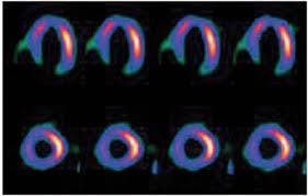 сцинтиграфия
