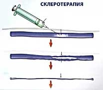 склеротерапия