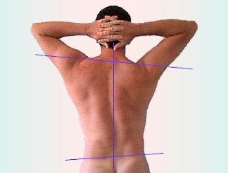 Висеть на перекладине можно людям с незначительным искривлением позвоночника