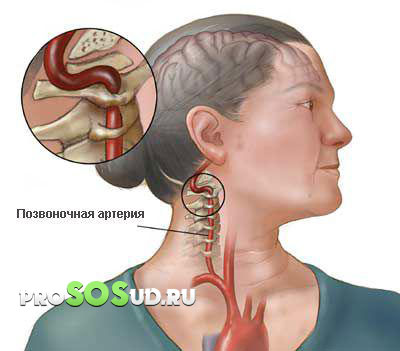 сдавленная артерия в области шеи