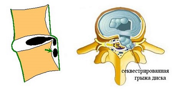 При секвестрации грыжи массаж запрещено делать