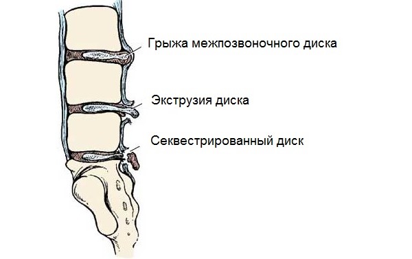 Разрыв фиброзного кольца проходит несколько стадий. Секвестрированное ядро диска - последняя стадия грыжи