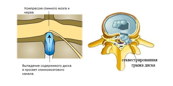 Обратите внимание в каких случаях требуется хирургическое лечение грыжи позвоночника