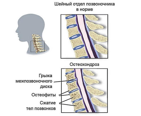 При остеохондрозе происходят деструктивные изменения в позвоночнике