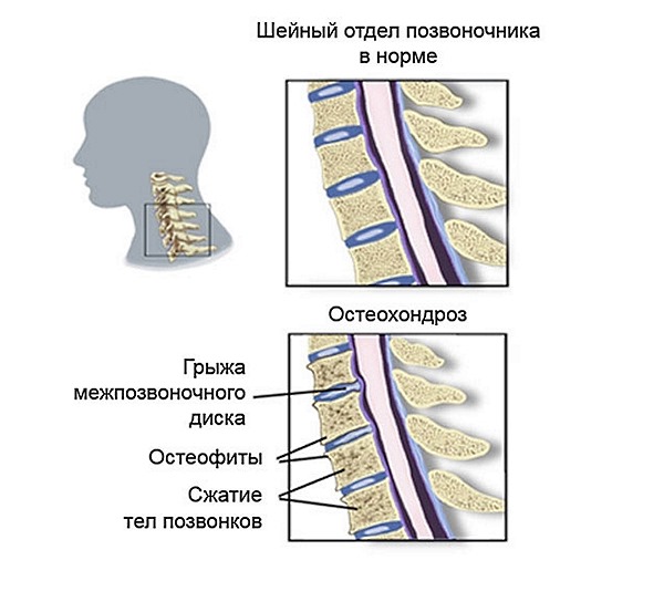 Остеохондроз шейного отдела позвоночника считается самым распространенным видом заболевания