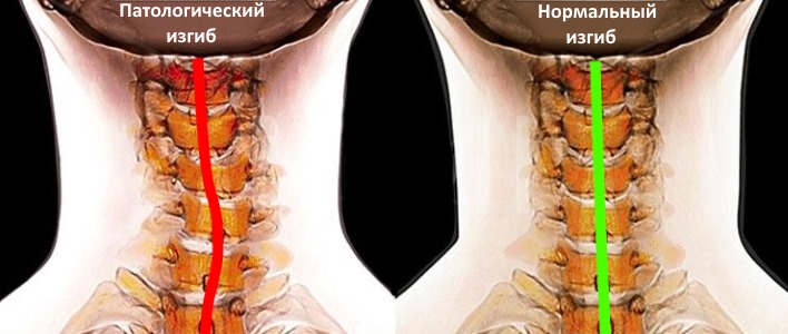 Шейный сколиоз относится к идиопатическим явлениям, так как возникает без причин
