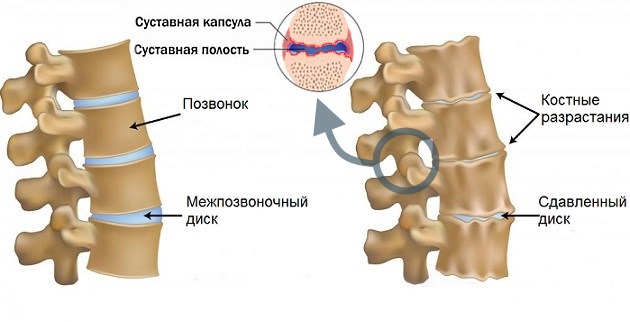 Артра МСМ форте показана при остеоартрозе и остеохондрозе позвоночника