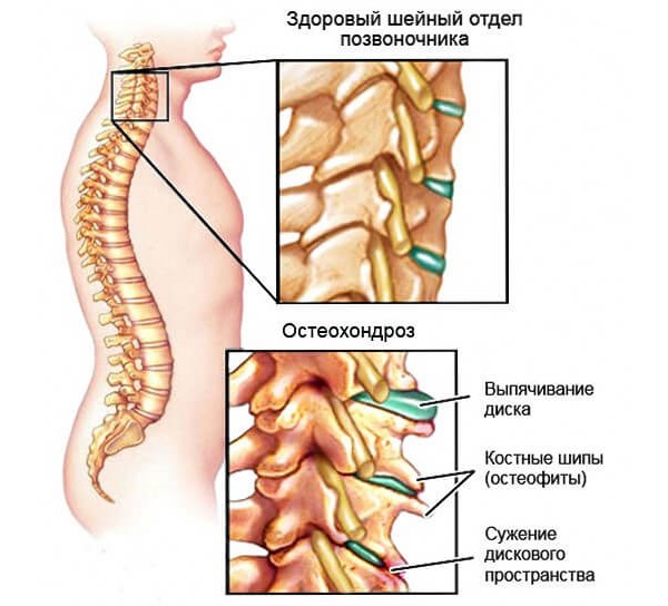 Цервикалгия появляется на фоне осложнений шейного остеохондроза