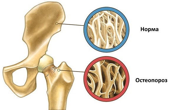 Применяют Форозу для лечения остеопороза и профилактики перелома шейки бедра