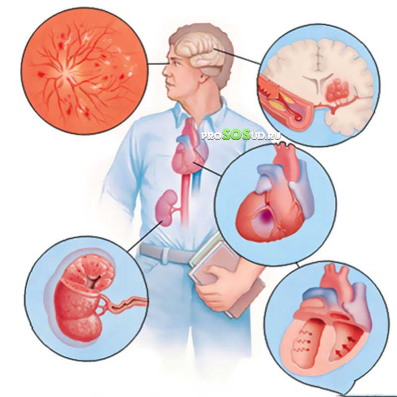 симптомы артериальной гипертензии