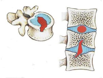 Если не лечить грыжу Шморля, то постепенно патология перерастает в межпозвоночною