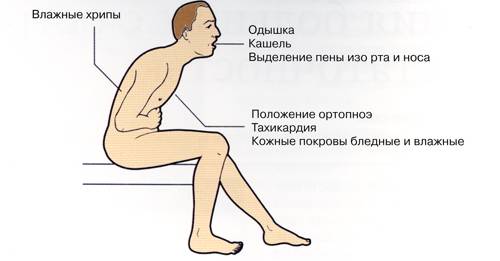 симптомы сердечной недостаточности