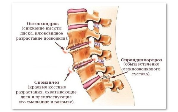 Ниже приведены виды дегенеративно-дистрофических изменений позвоночника в шейном отделе