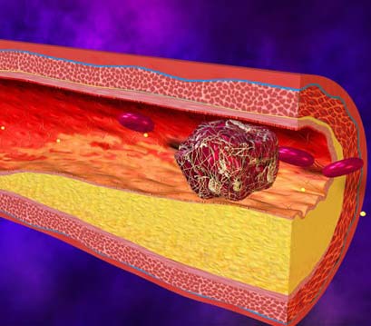 закупорилась вена