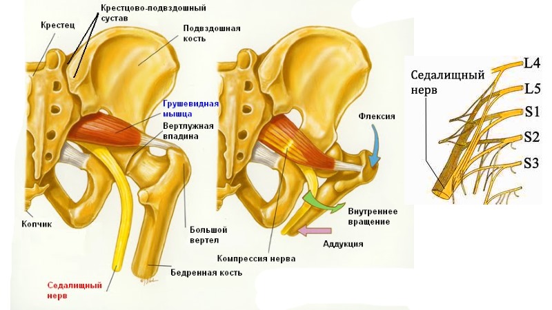 В зависимости от того, какая часть нерва воспаленная, ишиалгию делят на три типа