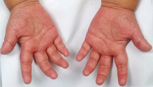 синдром Кавасаки