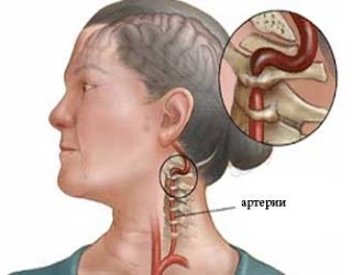 Все симптомы дегенеративных изменений в шейном отделе возникают из-за нарушения кровоснабжения мозга