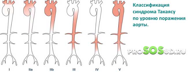 синдром такаяксу